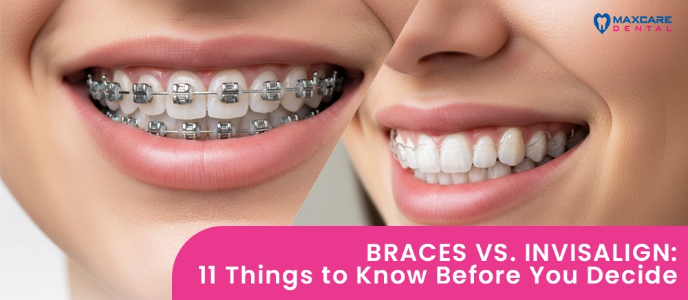Invisalign vs Braces NZ | Pros and Cons Explained